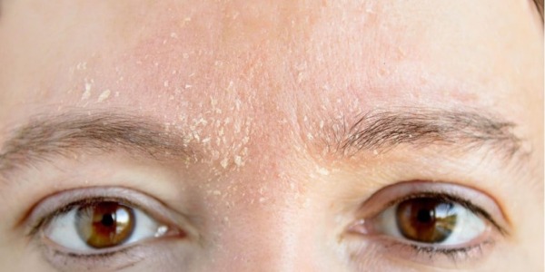 ¿Por qué se seca la piel en invierno?  La rutina hidratante que tu piel necesita.